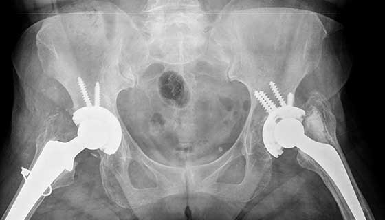 hip replacement for seniors
